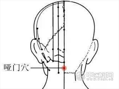 以哑门、扶突、环跳穴为主穴，针刺治疗中风后遗症